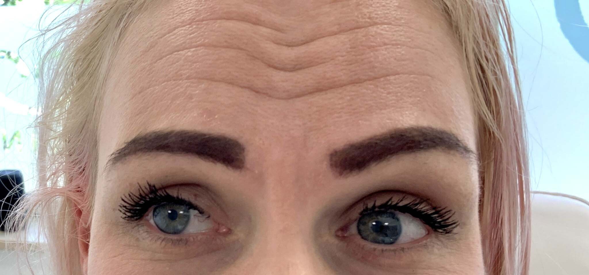 Startsituatie Botuline Toxine (Botox) bij kliniek 88
