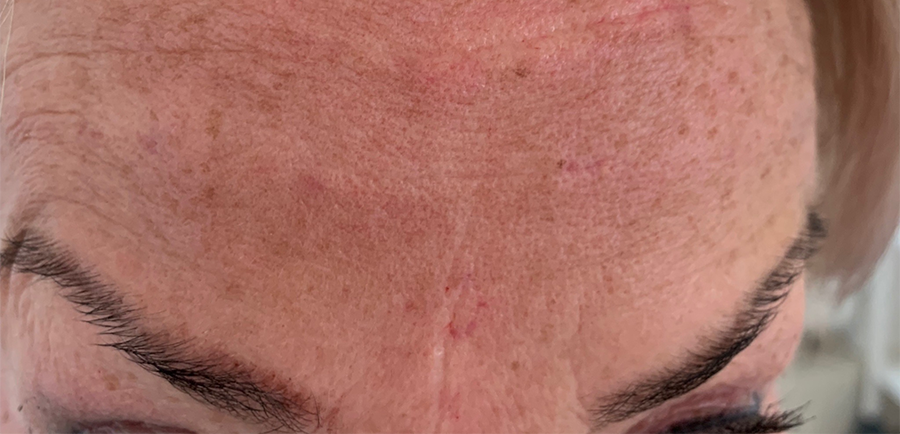 Startsituatie voor de Botuline Toxine (Botox) behandeling bij kliniek 88