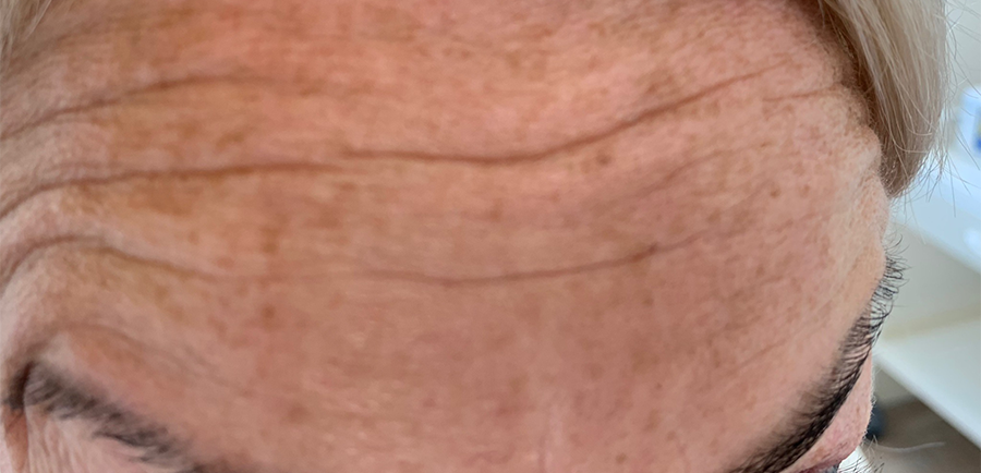 Startsituatie voor de Botuline Toxine (Botox) behandeling bij kliniek 88