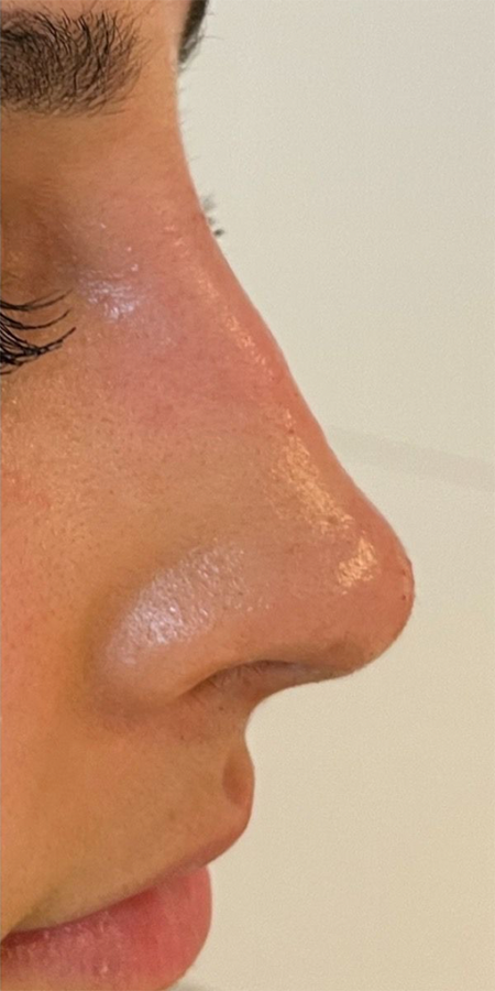 De start situatie van een neuscorrectie door middel van filler injecties bij kliniek 88