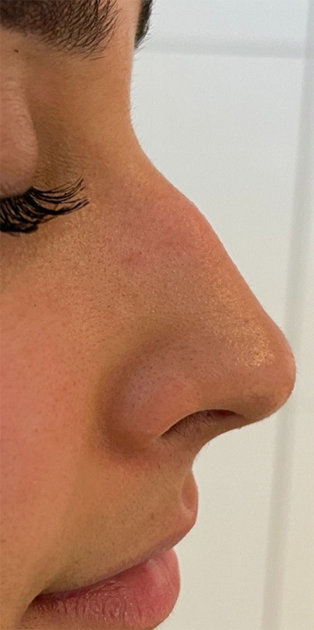 De start situatie van een neuscorrectie door middel van filler injecties bij kliniek 88