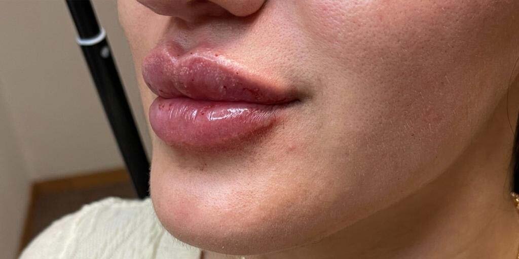Before lipfillers bij kliniek 88