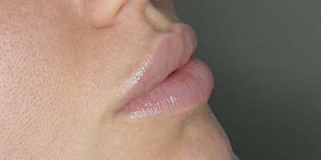 Before lipfillers bij Kliniek 88