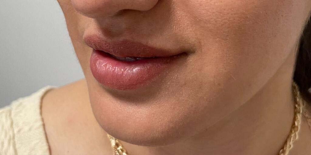 Before lipfillers bij kliniek 88
