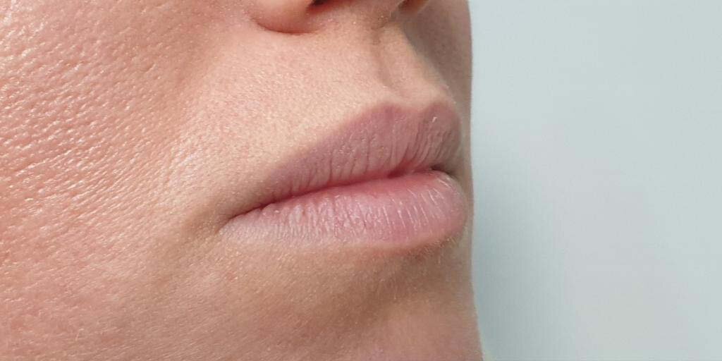 Before lipfillers bij Kliniek 88