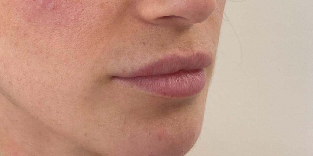 before van lipfillers bij Kliniek 88