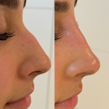 Neuscorrectie met fillers