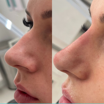 Neuscorrectie met fillers