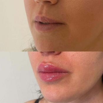 Resultaat van lipfillers bij Kliniek 88