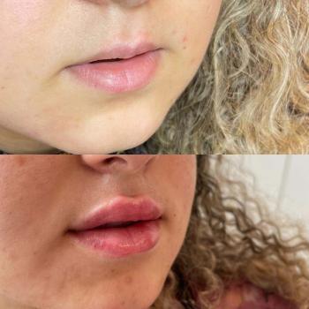 Resultaat van lipfillers bij Kliniek 88