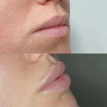 Resultaat van lipfillers bij Kliniek 88