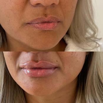Resultaat van lipfillers bij Kliniek 88