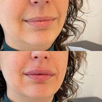 Resultaat van lipfiller behandeling bij Kliniek 88