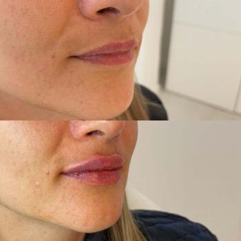 Resultaat van lipfillers behandeling bij Kliniek 88
