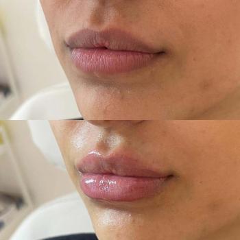 Resultaat van lipfillers bij Kliniek 88